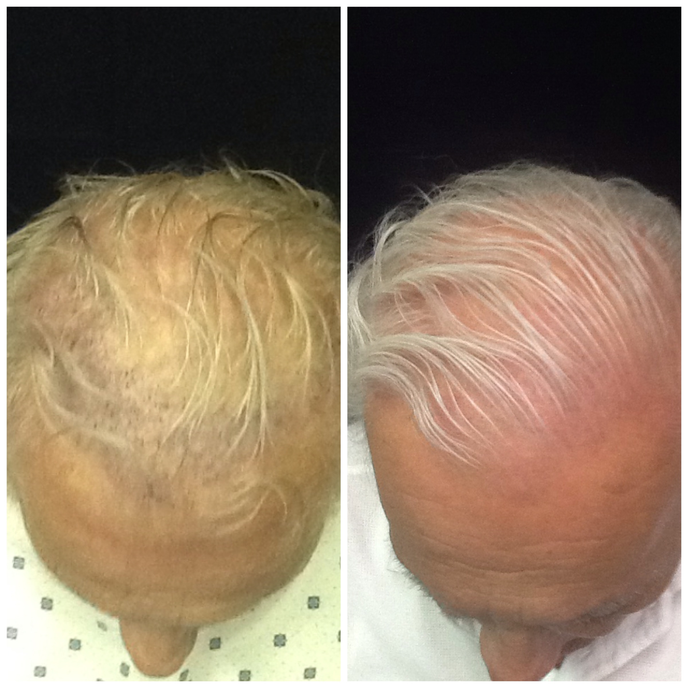 1000 Hair Graftsneograft | neograft before and 1month after 1000 grafts buckhead 1000 Hair Graftsneograft | neograft before and 1month after 1000 grafts buckhead