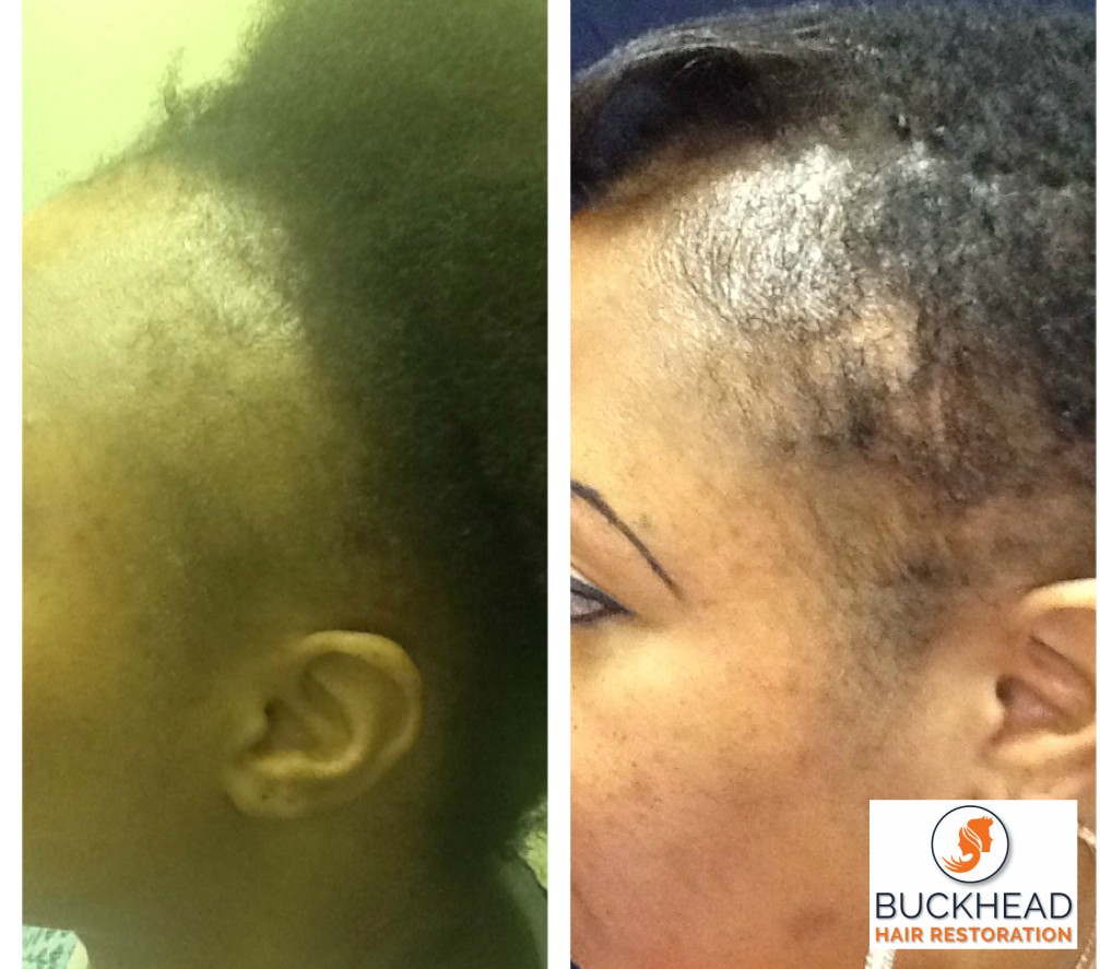 Picture shows African American Female suffering from Hair Loss called Traction Alopecia - before and after Platelet Rich Plasma Treatments for hair loss.
