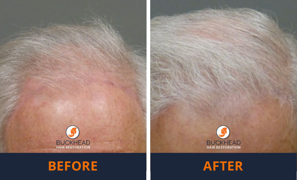 hair transplant results Before and After NeoGraft 2,000 Grafts- Hair Restoration Gallery at Buckhead Hair Restoration with Dr. Monte Slater
