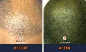 Thinning hair in african american male Before-and-After