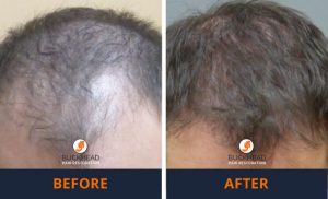 Before and After 2,500 Neograft Graft PRP Combination Treatment
