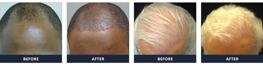 Hair Restoration Questions -Neograft Before and After Shots