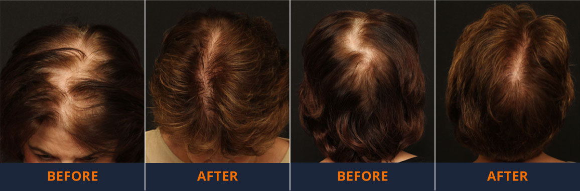 hair transplant results Before & After Neograft Treatment - Female suffering from Thinning Hair 