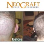 NeoGraft Hair Restoration for Men