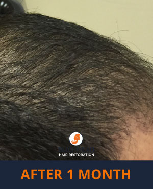Hair Restoration Results - Side view 1 month after NeoGraft