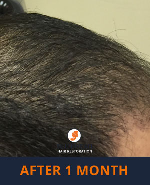 After-1-Month-2 Hair Restoration Results - Side view 1 month after NeoGraft