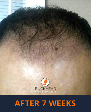 Hair Restoration Results Neograft patient after 7 weeks