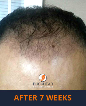 After-7-Weeks Hair Restoration Results Neograft patient after 7 weeks