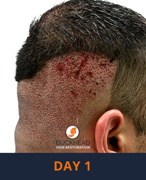 Day-1 Day 1 of Neograft Treatment