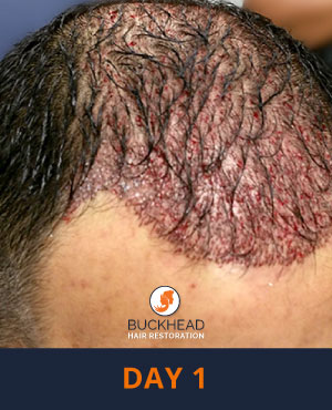 Day-1 Day 1 of Neograft Treatment