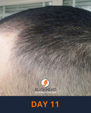 Day-11-3 Day 11 of Neograft Treatment