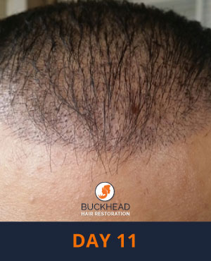 Day-11-3 Day 11 of Neograft Treatment