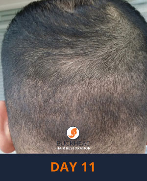 Day-11 Hair Restoration Questions and answers Day 11 of Neograft Treatment