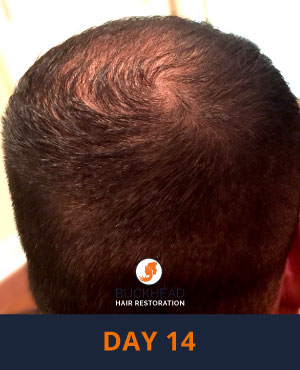 Day-14 Day 14 of Neograft Treatment