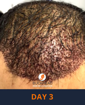 Day-3-1 Day 3 of Neograft Treatment