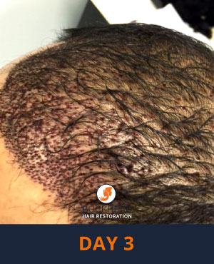Day-3-3 Day 3 of Neograft Treatment