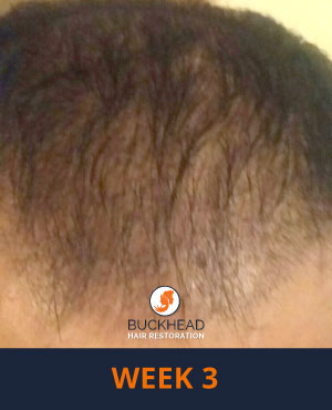 Week-3-2 Week 3 of Neograft Treatment