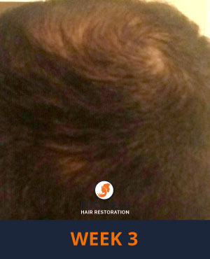Week-3 Week 3 of Neograft Treatment