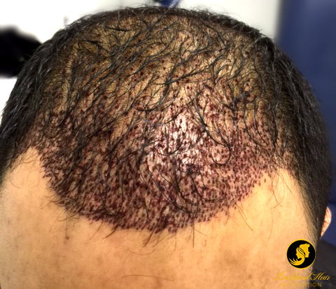 NeoGraft Hair Restoration Frontal View 2500 Grafts