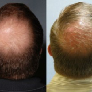 Male Balding issue