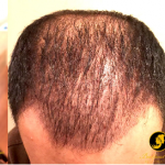 Neograft Hair Restoration Results