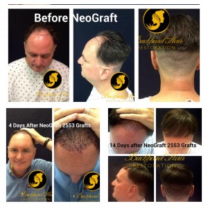 NeoGraft Hair Restoration