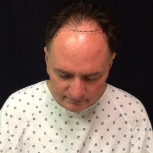Michael Graham Hair Restoration Journey