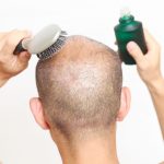 PRP Therapy for Hair Loss Prp and neograft