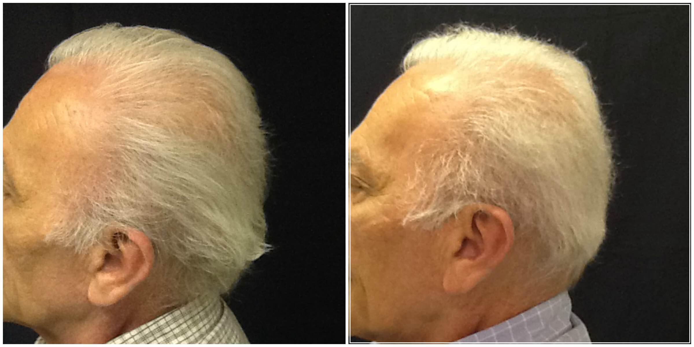 Neograft Hair Restoration Buckhead