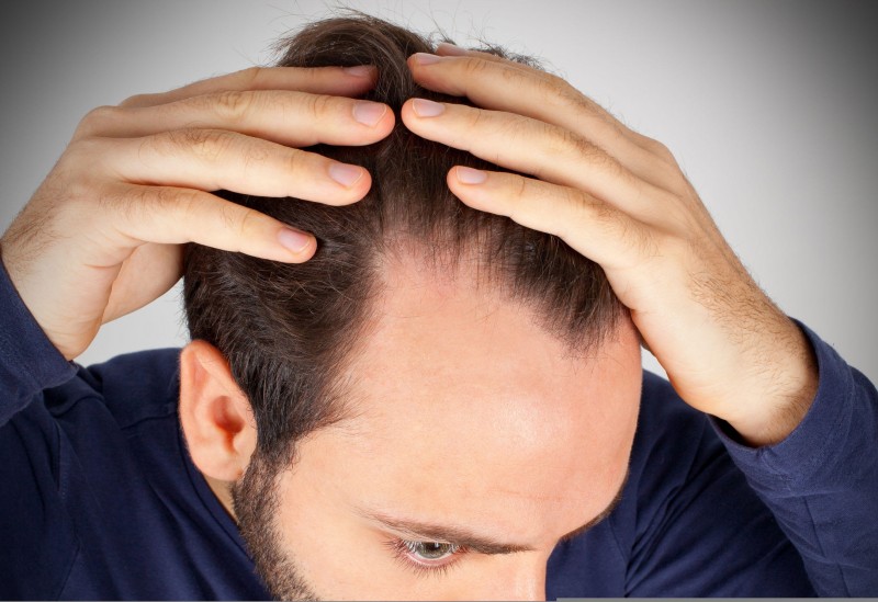 Stop Male Pattern Baldness With NeoGraft Hair Restoration