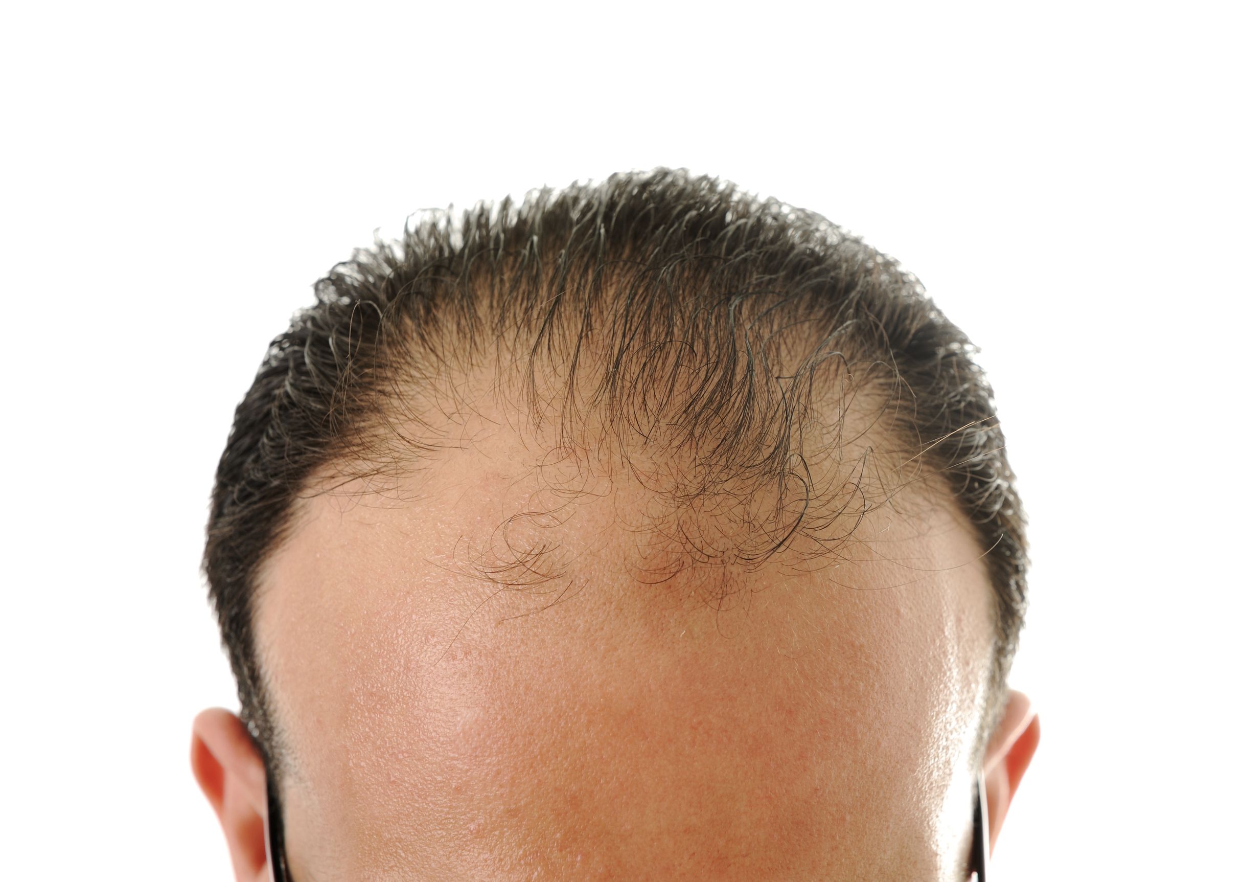 NeoGraft hair restoration 653 grafts Before & 6 month after