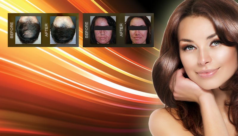 NeoLTS light therapy for hair loss