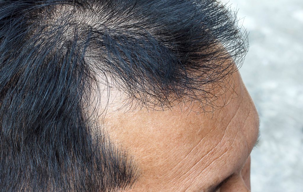 stop thinning hair today