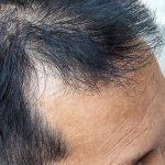 stop hiding bald spots thinning hair today