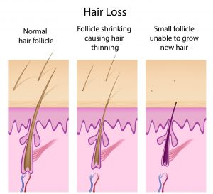 hair restoration in Atlanta 