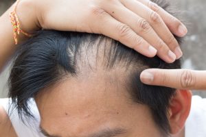 Platelet Rich Plasma Hair Loss Therapy