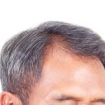 Why Are You Losing Your Hair great hair loss solutions in 2017.
