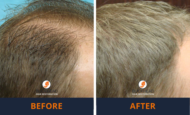 thinning hair - FUE Follicular Unit Extraction Method