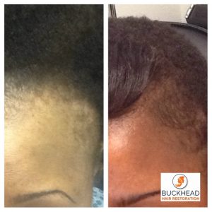 11 month Post FUE Follicular Unit Extraction Hair Restoration 1859 Grafts and PRP Therapy 