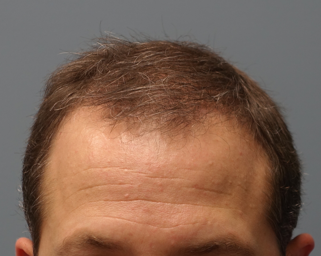 Permanent Hair Restoration