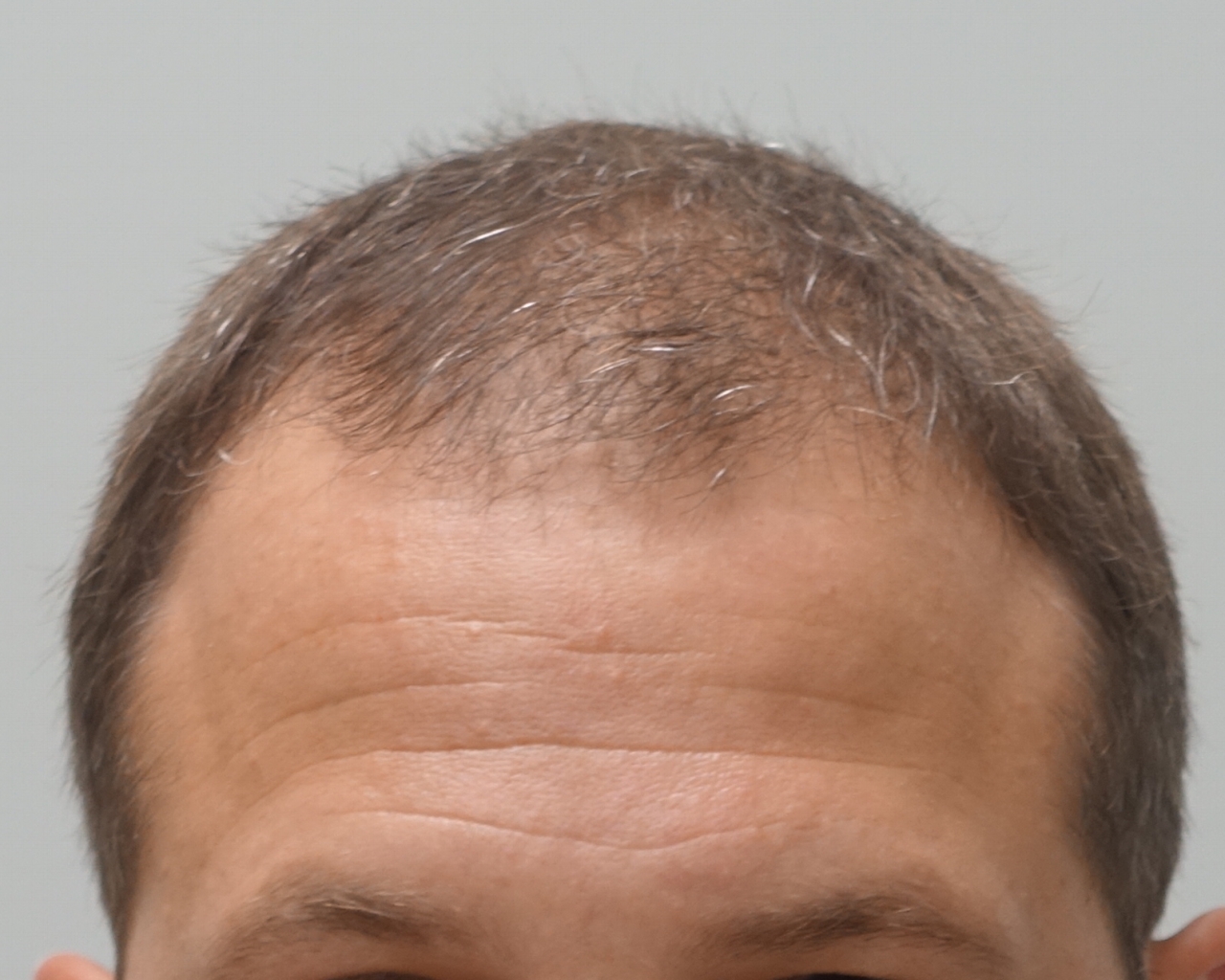 Permanent Hair Restoration