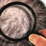 Seven Most Common Hair Loss Questions and Answers- HairLoss Solutions at Buckhead Hair Restoration in Atlanta and Warner Robins, Georgia