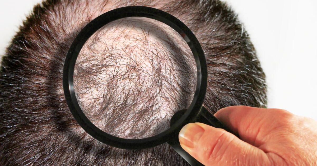 Most Common Hair Loss Questions Answered Buckhead Hair Restoration