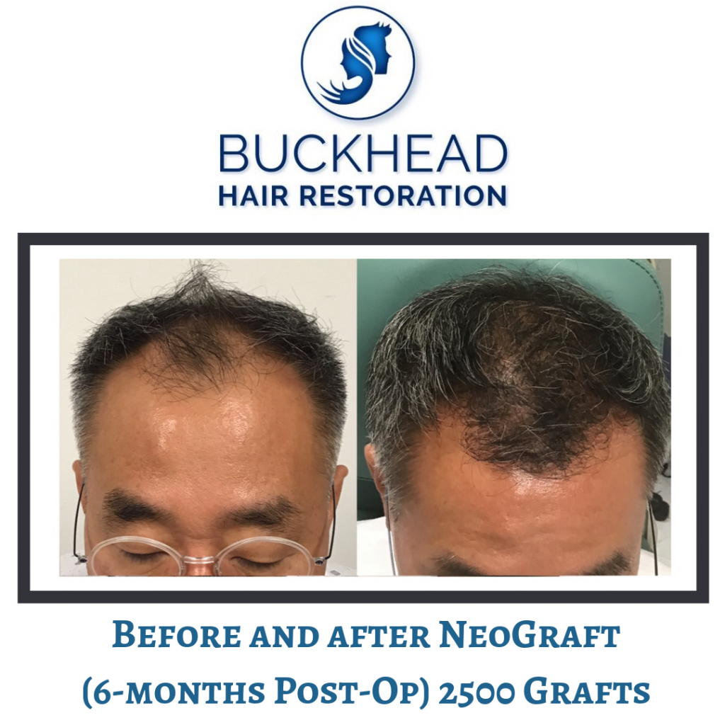 Before and after Neograft Hair Restoration with Dr. Slater and team in Atlanta. Patient had 2500 grafts (6months post-op)