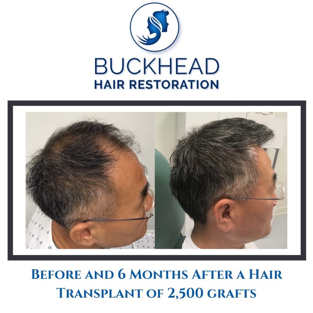 Before and after Neograft Hair Restoration with Dr. Slater and team in Atlanta. Patient had 2500 grafts (6months post-op)