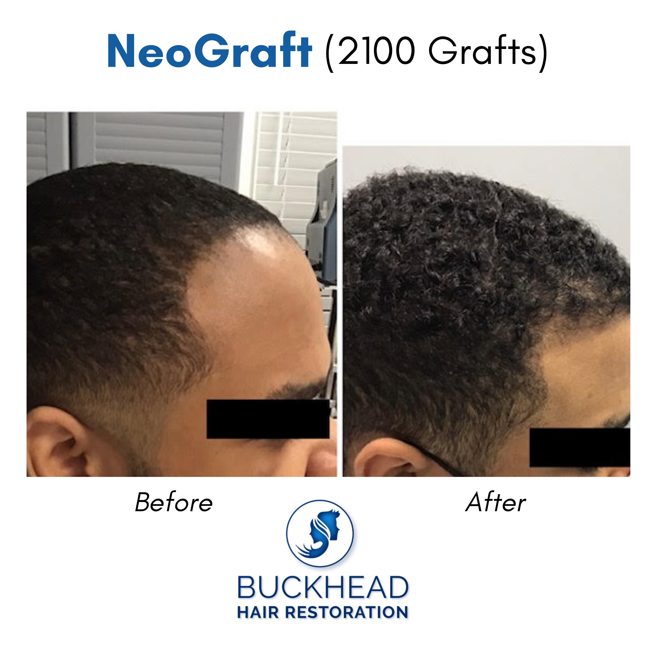 NeoGraft Overview | No Linear Scar | Fast Recovery | Buckhead Location