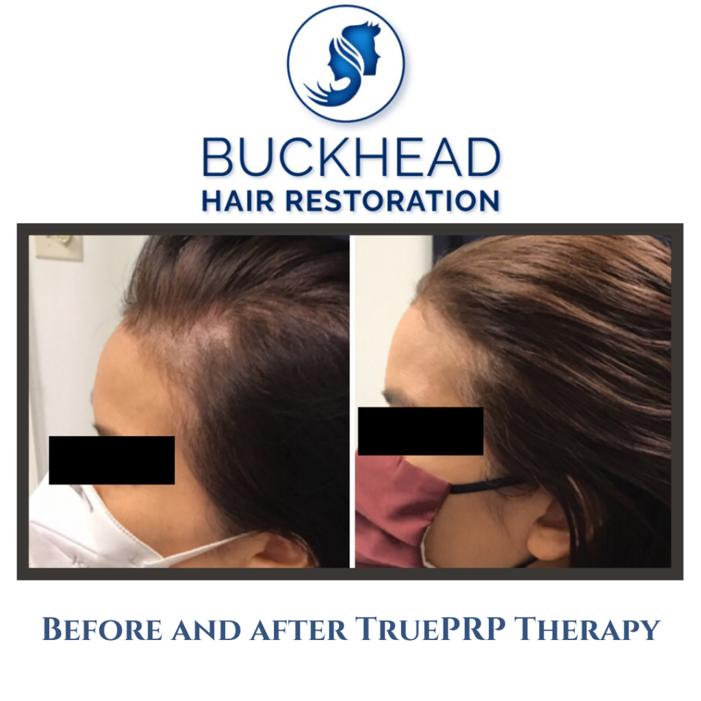 Before & After PRP Hair Restoration with Buckhead Hair Restoration