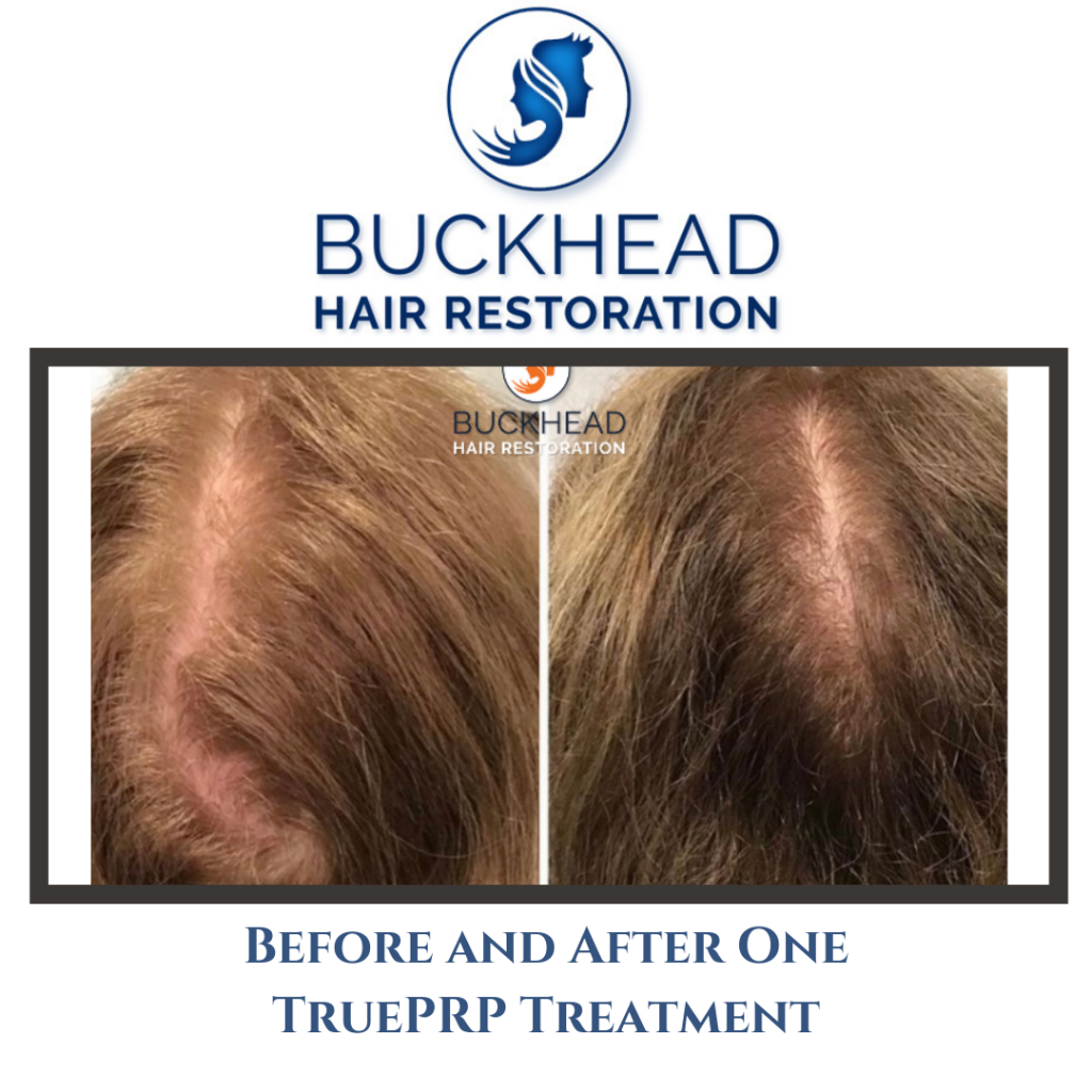 Before & After PRP Hair Restoration with Buckhead Hair Restoration