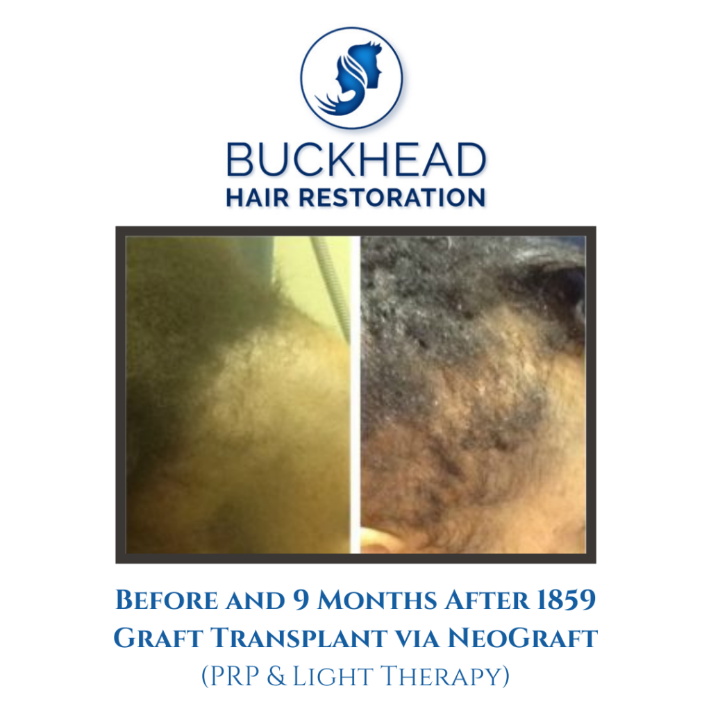 Side View – Before and after 9-Months NeoGraft – 1859 Grafts (PRP Therapy & Light Therapy)