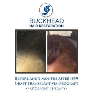 Front View Before and after 9-Months NeoGraft – 1859 Grafts (PRP Therapy & Light Therapy)
